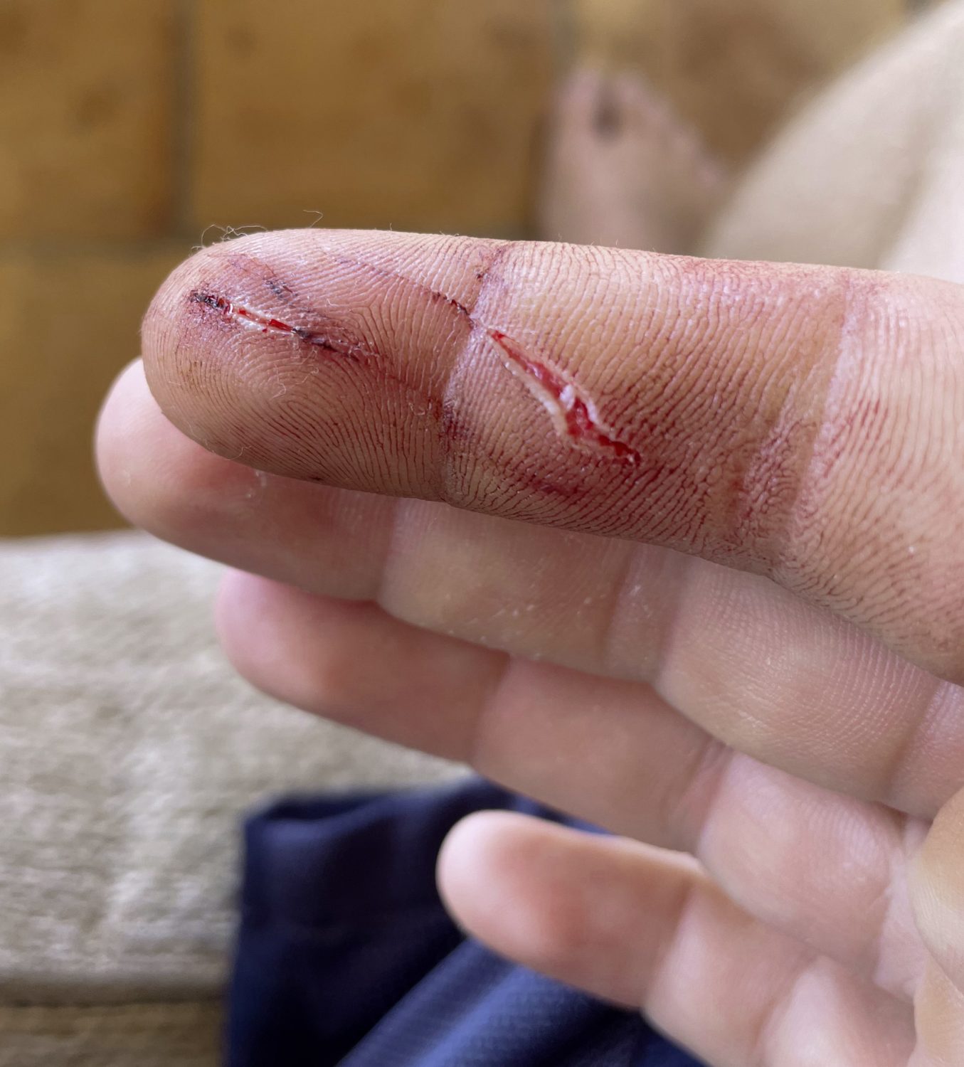 Muränenbiss Verletzung